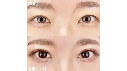 TCB八王子院で受けた二重手術のビフォーアフター写真