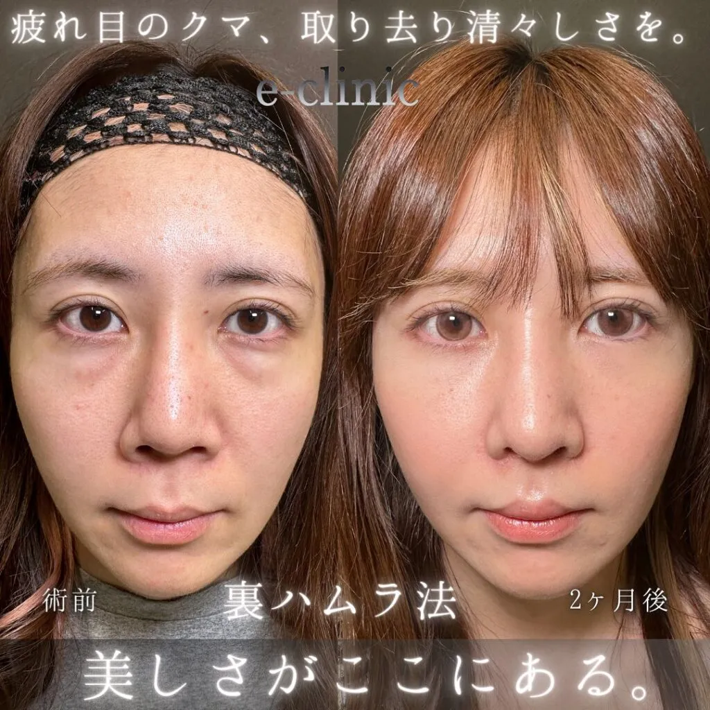 eクリニック伊藤渉医師の施術裏ハムラ法症例画像1
