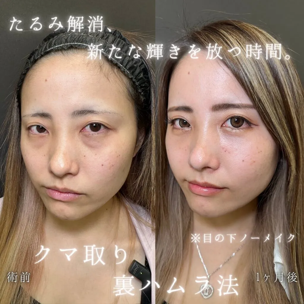 eクリニック伊藤渉医師の施術裏ハムラ法症例画像2