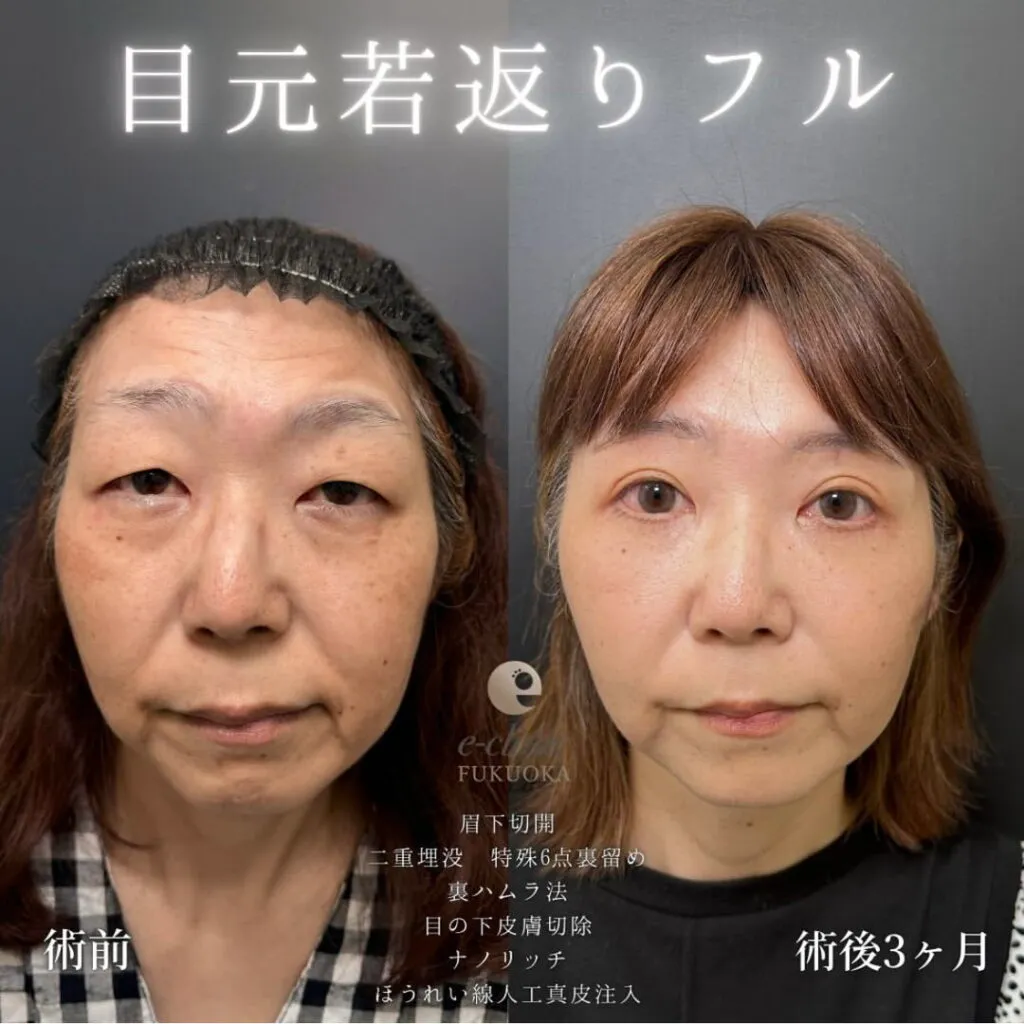 eクリニック伊藤渉医師の施術目元若返りフル症例画像