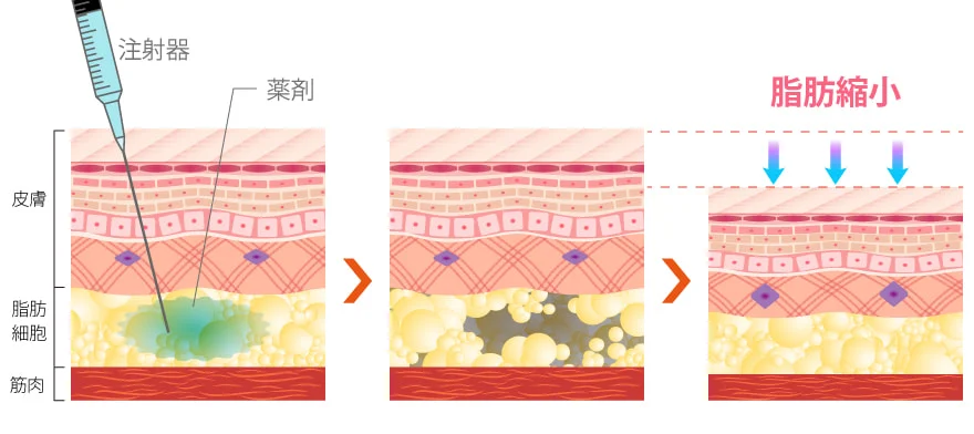 脂肪溶解注射で脂肪が縮小するメカニズム