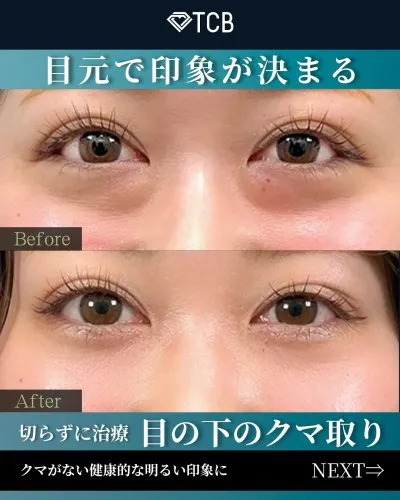 TCB村田大典医師の口コミ評判・経歴は?症例写真クマ取り1