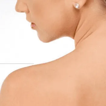 東京美容外科の肩ボトックスのイメージ