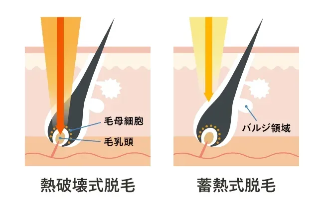 熱破壊式脱毛と蓄熱式脱毛