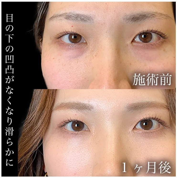 eクリニックのハムラ法