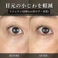 大宮でリジュランが安いおすすめクリニックLULA症例