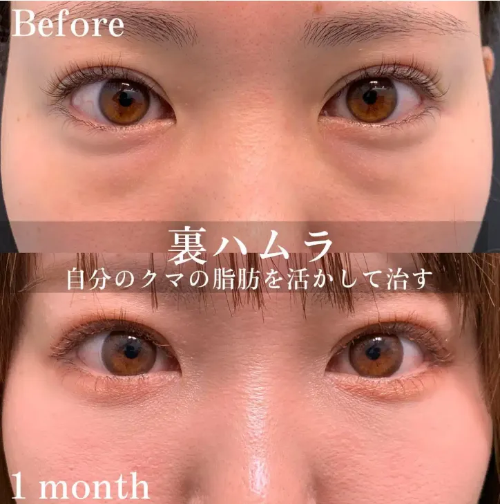 eクリニックの裏ハムラ法