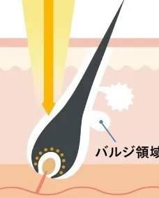レジーナクリニック　蓄熱式レーザー画像