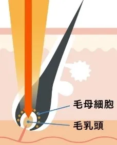 レジーナクリニック　熱破壊式レーザー画像