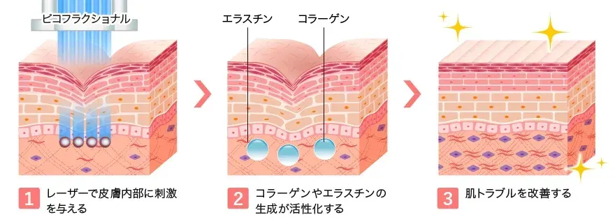 TCB神戸院のピコレーザー ピコフラクショナルのイメージ画像