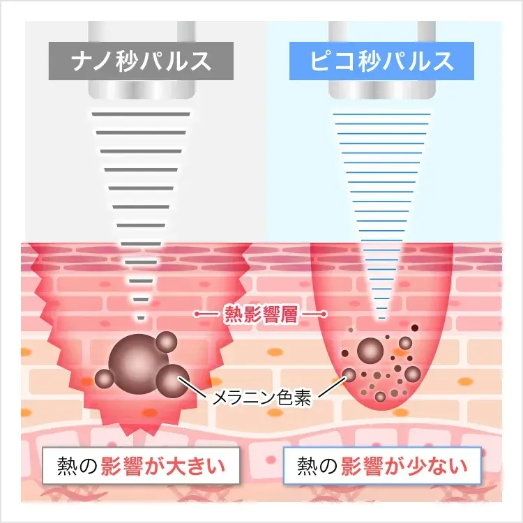 TCB神戸院のピコレーザー ピコスポットのイメージ画像