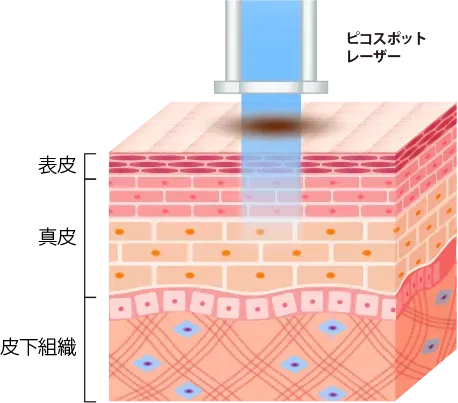 ピコスポットレーザーの施術イメージ画像