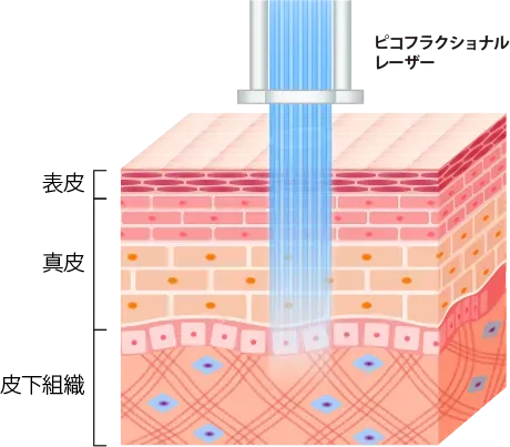 ピコフラクショナルの施術イメージ画像
