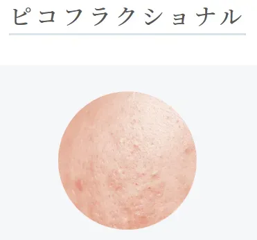 ルラ美容クリニック札幌院のピコフラクショナルに効果のある肌