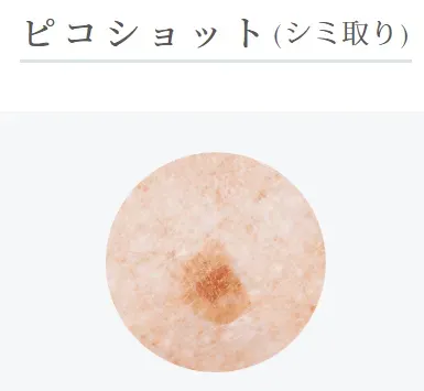 ルラ美容クリニック札幌院のピコショットに効果のある肌