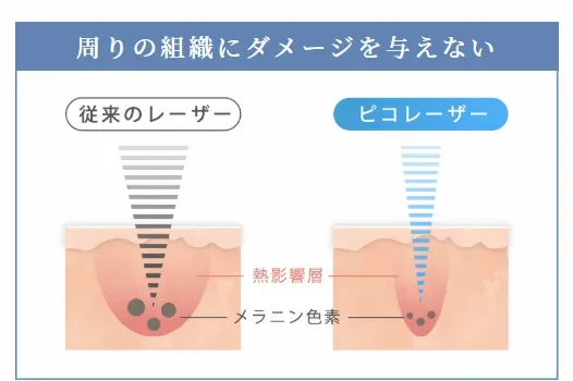ルラ美容クリニック横浜院のピコレーザー治療はダメージが少ない