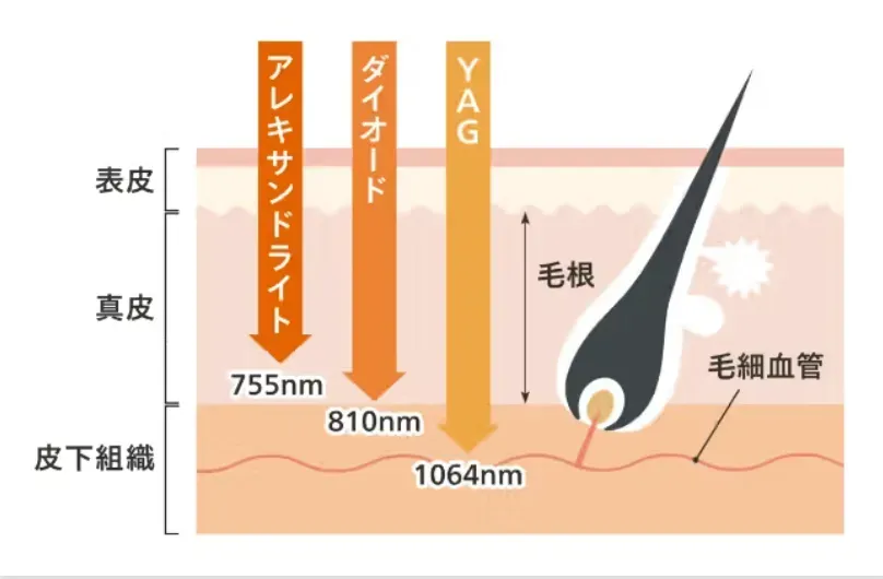 医療レーザー図解