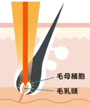 熱破壊式毛