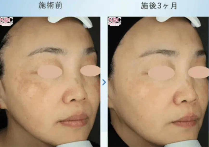 施術前後の写真(3ヶ月後)