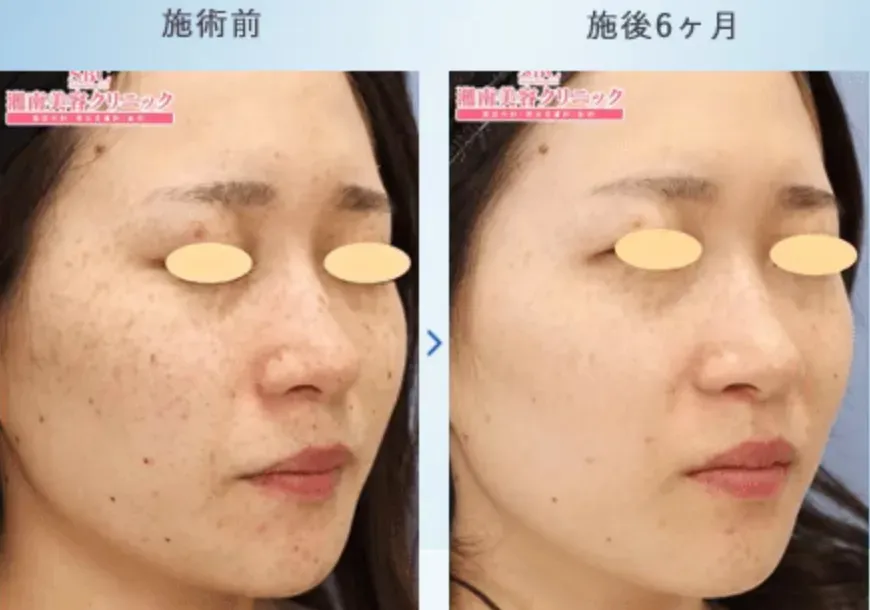 施術前後の写真(6ヶ月後)