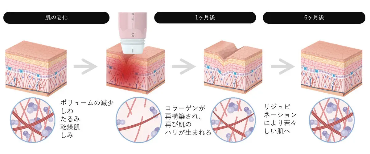 ボルニューマの効果発現
