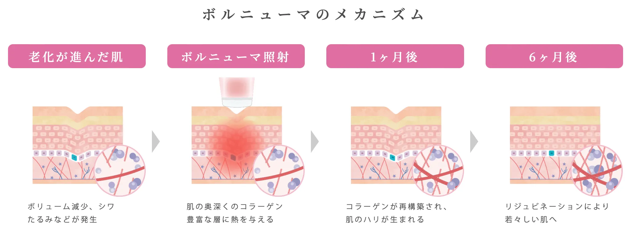 ルラ美容クリニック ボルニューマのメカニズム