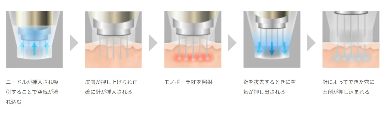 ポテンツァのマイクロニードルと高周波を使用した施術説明