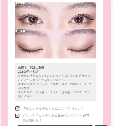 二重術の自然な仕上がり