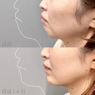 TCB佐藤麻未医師の口コミ評判は?失敗しない? 経歴についても調査! 小顔美肌再生(リフトアップ)の症例写真