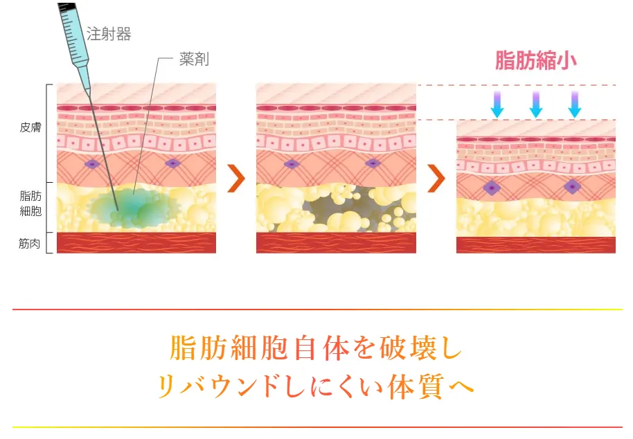 TCB　脂肪溶解注射について解説画像