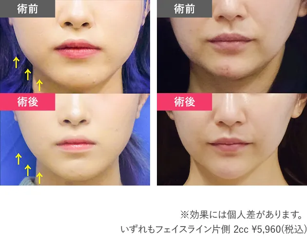 TCB　脂肪溶解注射の症例写真の画像