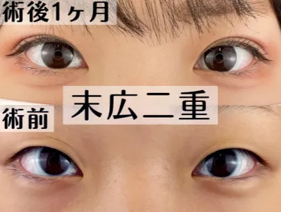 TCB姫路院の口コミ評判•レビュー【評価は高い？】徹底調査！　二重整形の症例写真