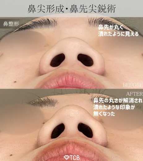 TCB篠永宏行医師の口コミ評判・経歴は？自然な仕上がりが人気の理由を解説　篠永宏行医師の鼻尖形成・鼻先尖鋭術症例写真