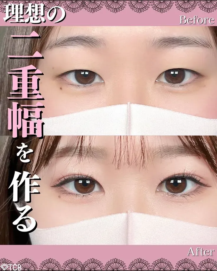 TCB金沢院における施術例理想の二重幅を作るビフォーアフター