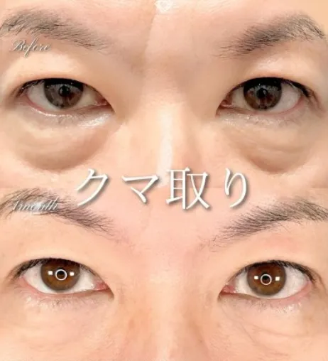 TCB神戸院の口コミ評判•レビュー【経験者にアンケート調査】専門家監修! クマ取りの症例写真