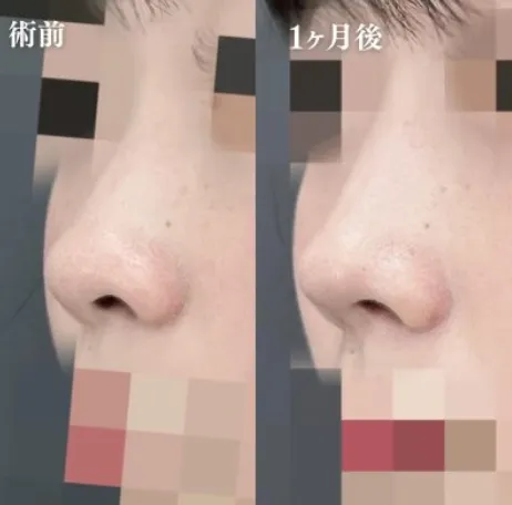 TCB神戸院の口コミ評判•レビュー【経験者にアンケート調査】専門家監修! 鼻整形の症例写真