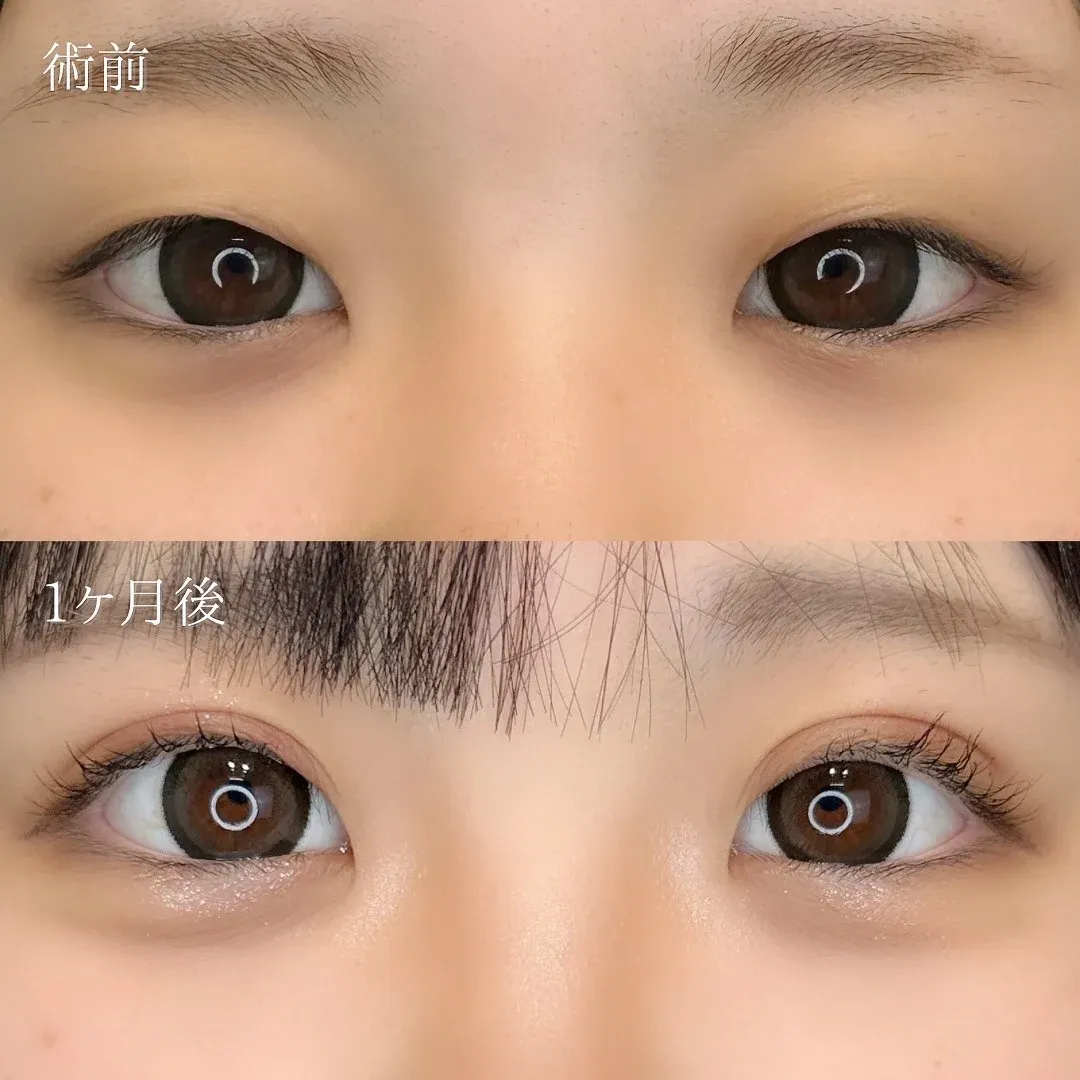TCB那覇院の二重術のビフォーアフター