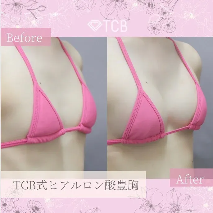TCB新宿東口院のヒアルロン酸豊胸術のビフォーアフター