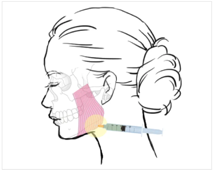 エラボトックスとは?