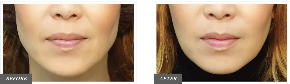 エラボトックスの実際の写真