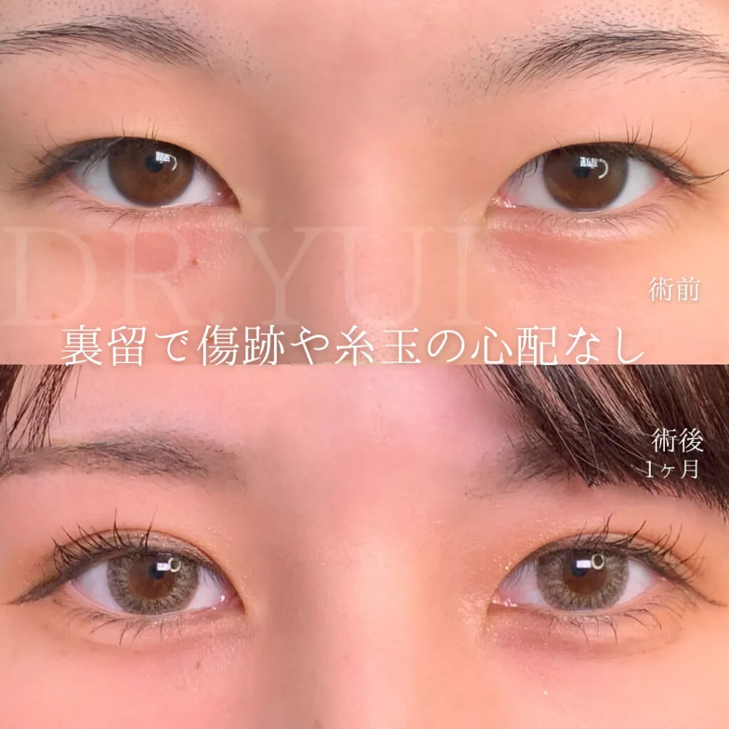 eクリニック坂本優衣医師の目元の施術画像