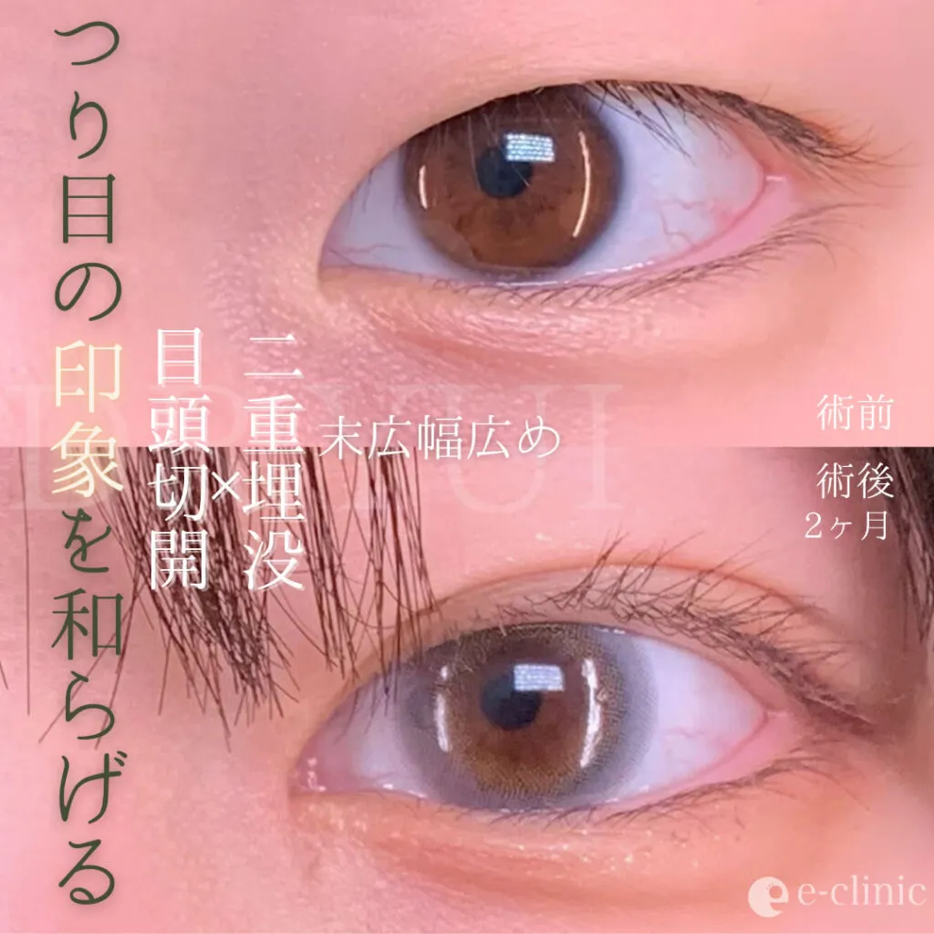 eクリニック坂本優衣医師の目頭切開画像