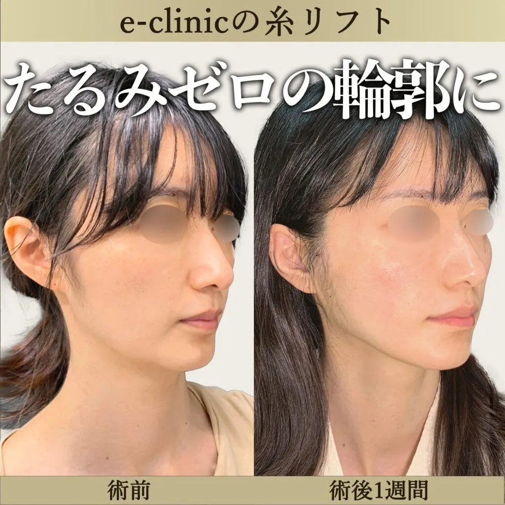 eクリニック坂本優衣医師の糸リフト施術画像