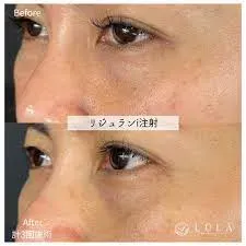 梅田でリジュランが安いおすすめクリニックLULA効果