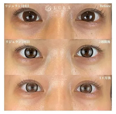 梅田でリジュランが安いおすすめクリニックLULA症例写真