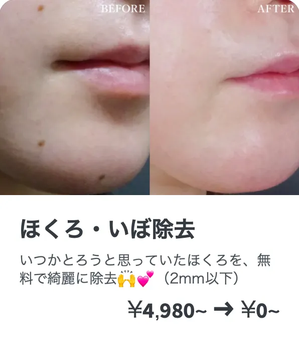 TCBのほくろ・いぼ除去の症例