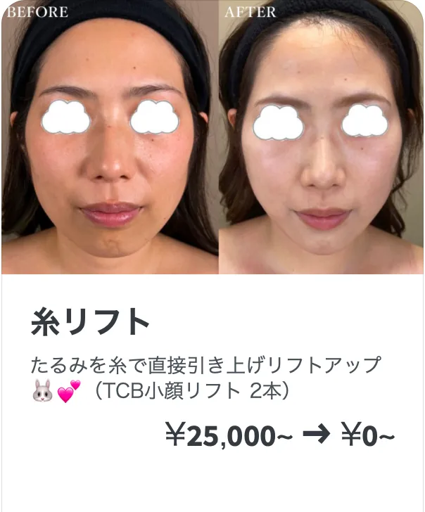 TCBの糸リフトの症例