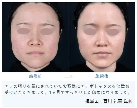 湘南美容クリニック　ボトックス症例写真