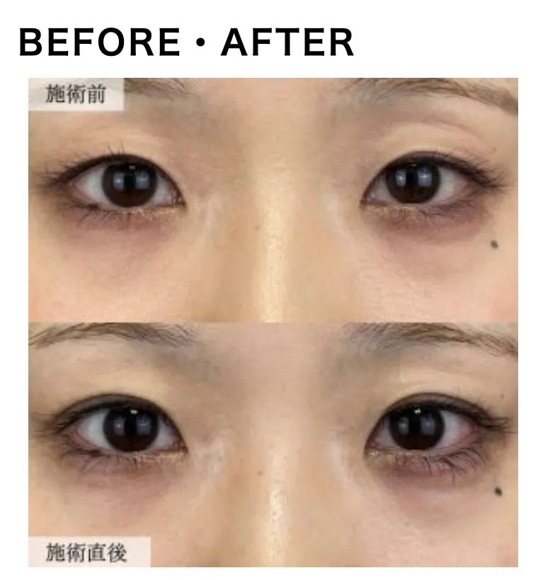 tcbの二重整形の症例写真4
