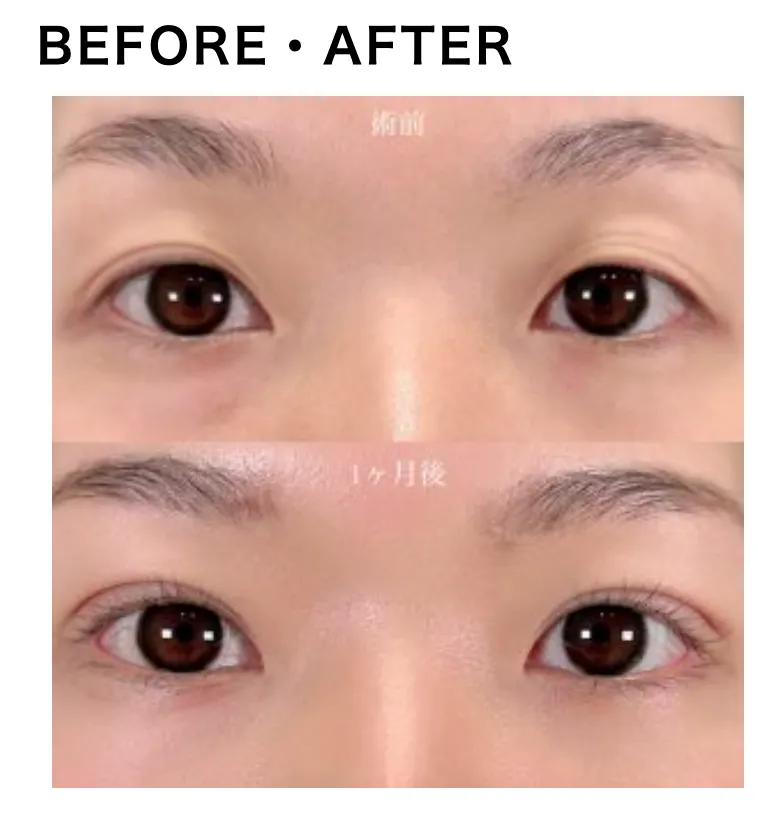 tcbの二重整形の症例写真１